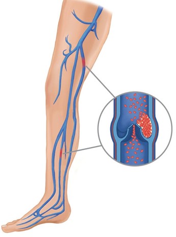 Causes for varicose veins(1)