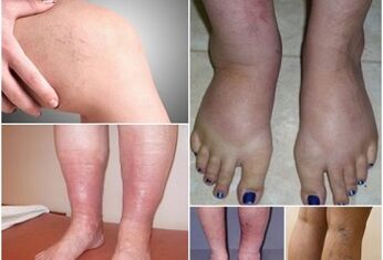 Photos of manifestations of varicose veins on the legs