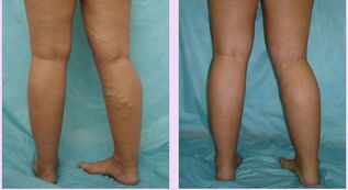 How are varicose veins of the first stage manifest
