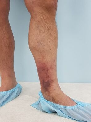 Complications from varicose veins in men