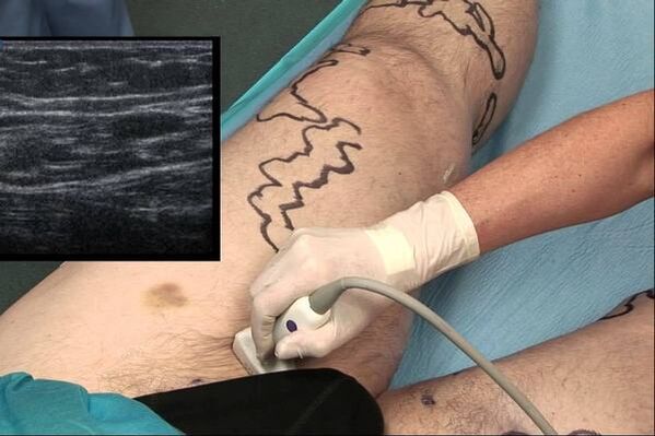 Diagnosis of varicose veins in men