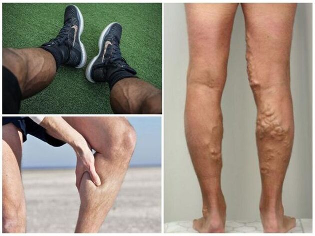 What varicose veins look like on men's legs