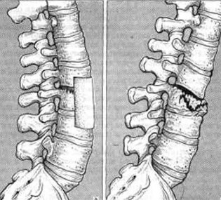Injuries in the lumbar spine
