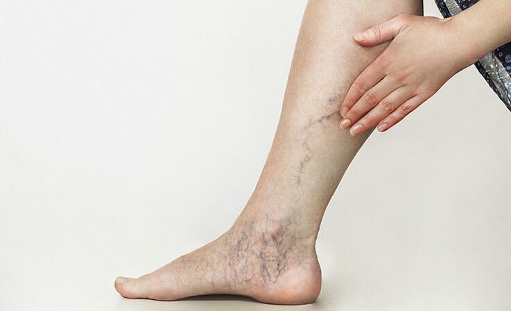Varicose veins and their treatment with folk remedies