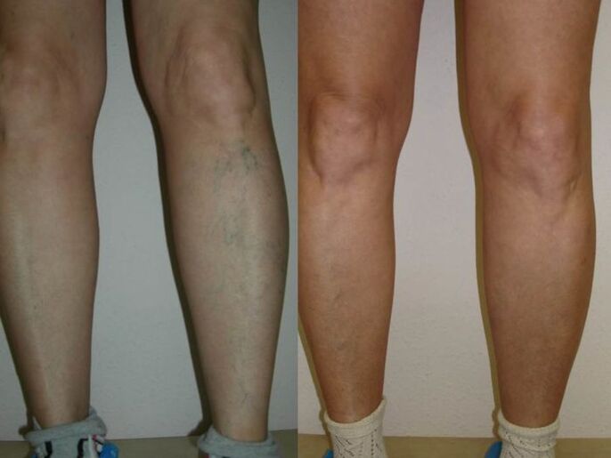 Legs before and after varicose veins laser treatment