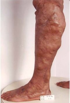 Manifestations of chronic venous insufficiency in the lower extremities