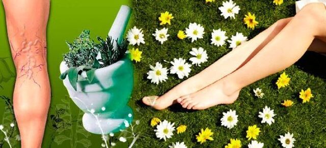 Folk remedies for varicose veins in the legs, which will help speed recovery