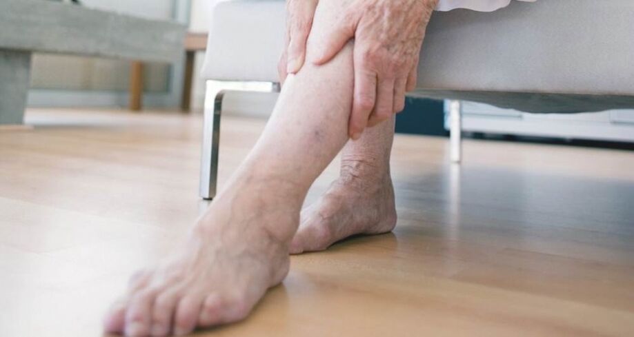 Varicose veins of the lower extremities caused by a malfunction of the venous valve