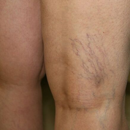 Venous networks on the lower extremities are a sign of varicose veins