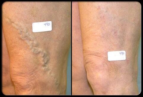Before and after the operation in the veins