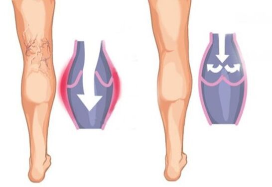 what varicose veins look like