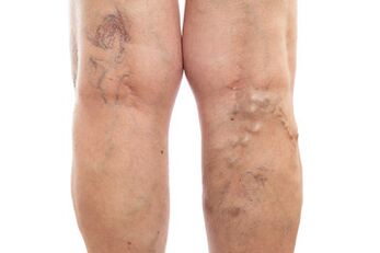 Varicose veins of the lower extremities