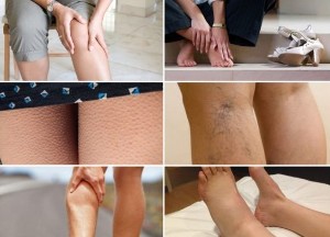 The primary symptoms of varicose veins